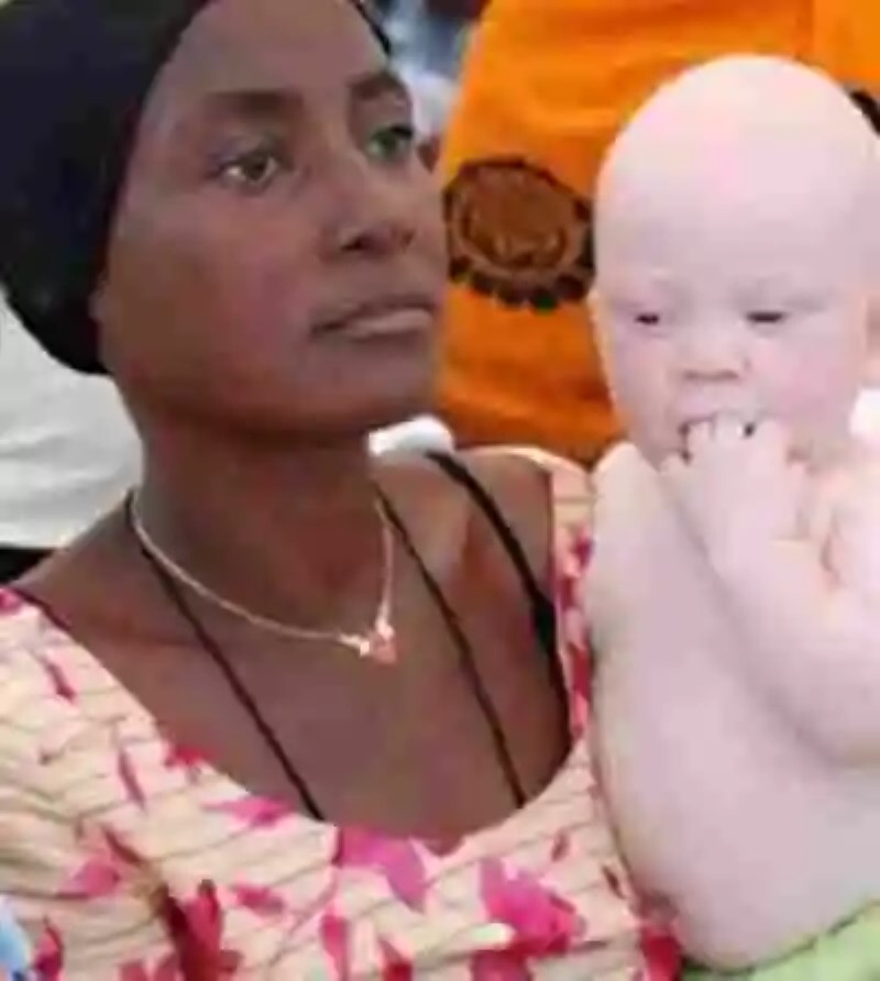 La desgracia de ser albino en Tanzania