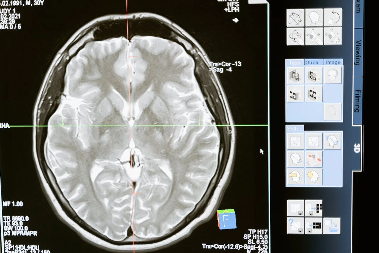 Advances in Brain Tumor Imaging: Enhancing Diagnosis and Monitoring