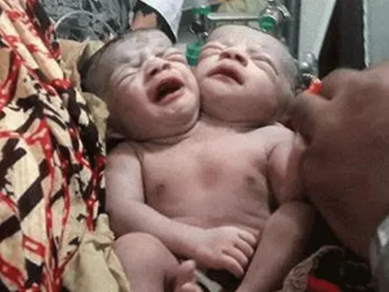En Bangladesh nace una niña con dos cabezas